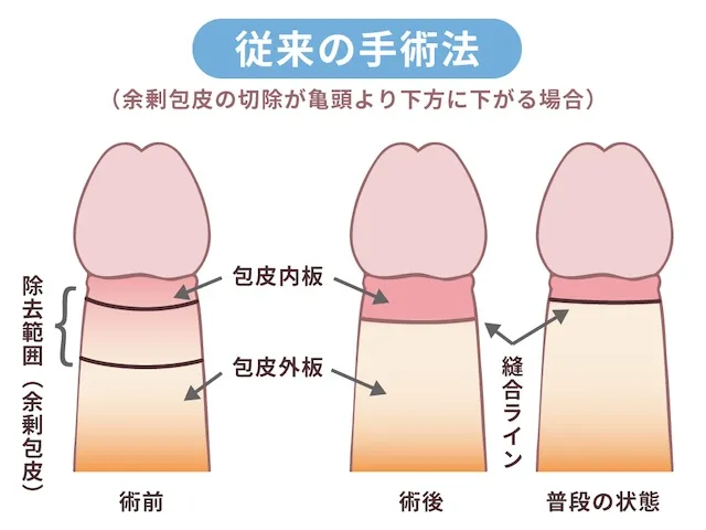 環状切開術