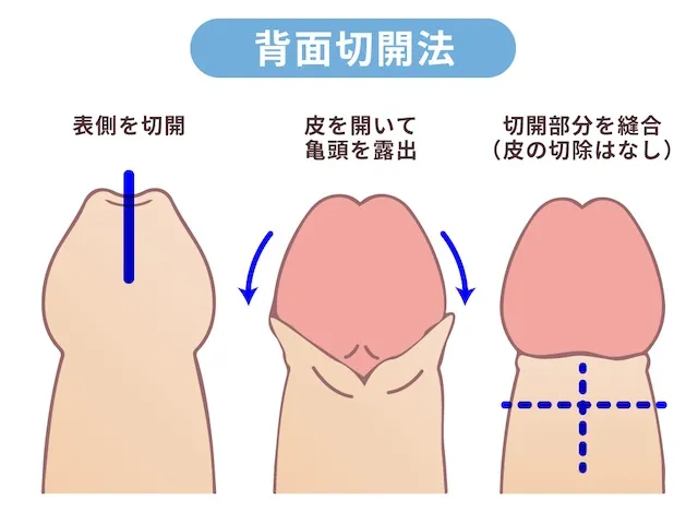 背面切開術