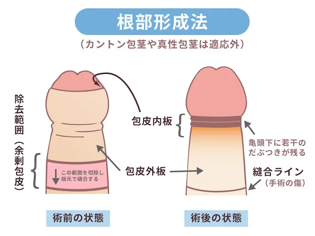 根部環状切除術