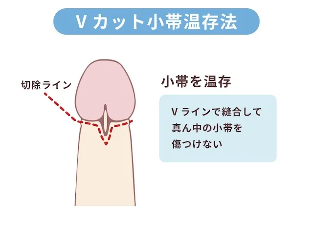 Vカット小帯温存法