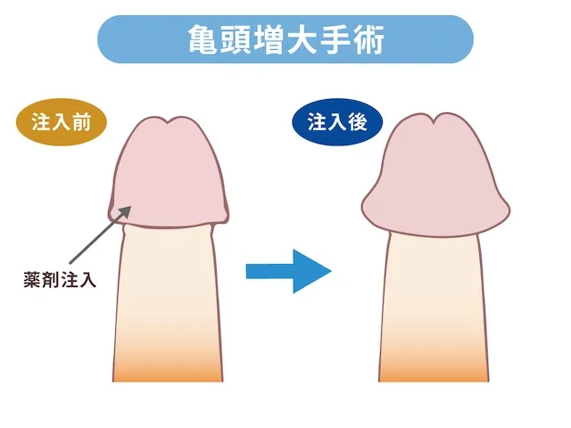 亀頭増大手術