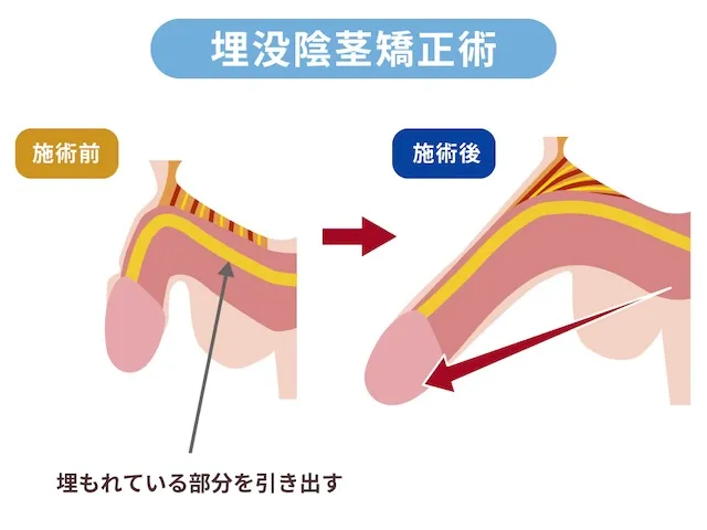 埋没陰茎矯正術