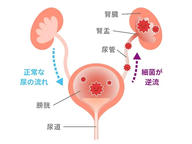 尿路感染症