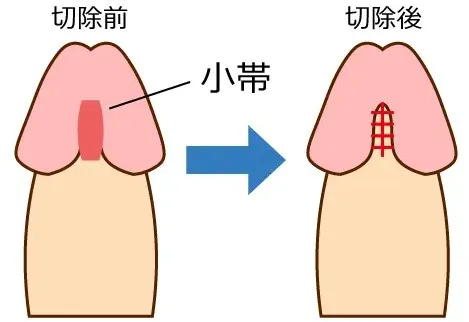 小帯形成術