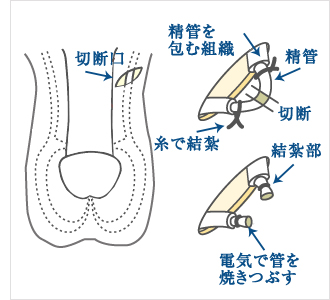 パイプカットを行う部位と方法