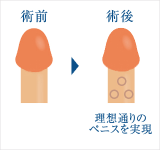 シリコンボール挿入の術前と術後の図