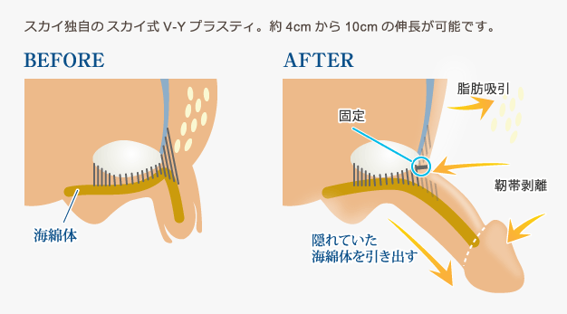 スカイV-Yプラスティ